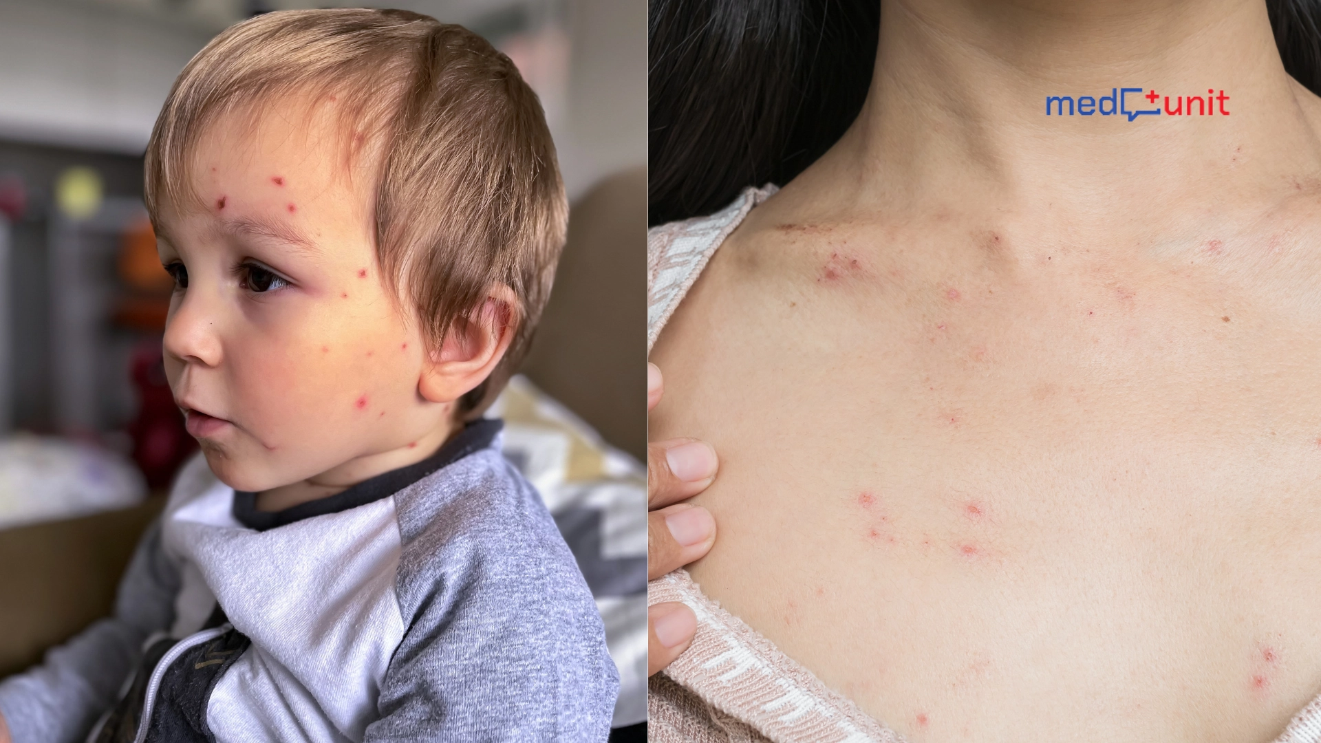 Wysypka po antybiotyku - objawy, przyczyny, leczenie - MEDUNIT.PL